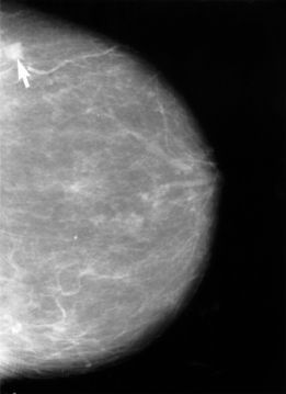 screening mammography breast cancer by Jeffrey Dach md