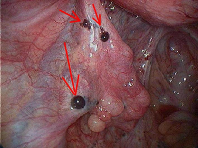 Endometrial Implants Jeffrey Dach MD_2