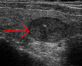 benign_nodule_thyroid_ultrasound