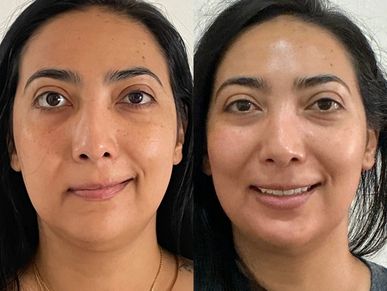 Rehabilitación Parálisis Facial