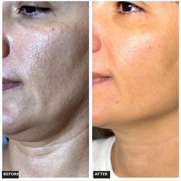 Before and after Endolift jawline improvement