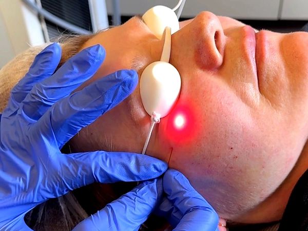 Endolift fiber under the skin