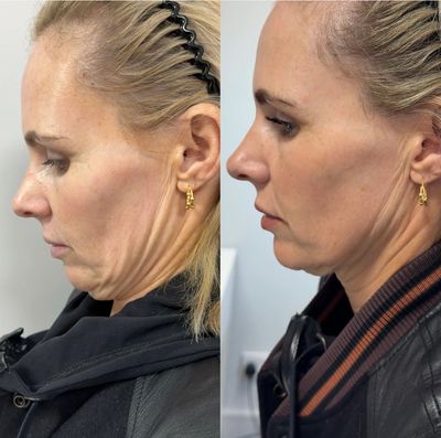 Skin tightening in submental area after Endolift