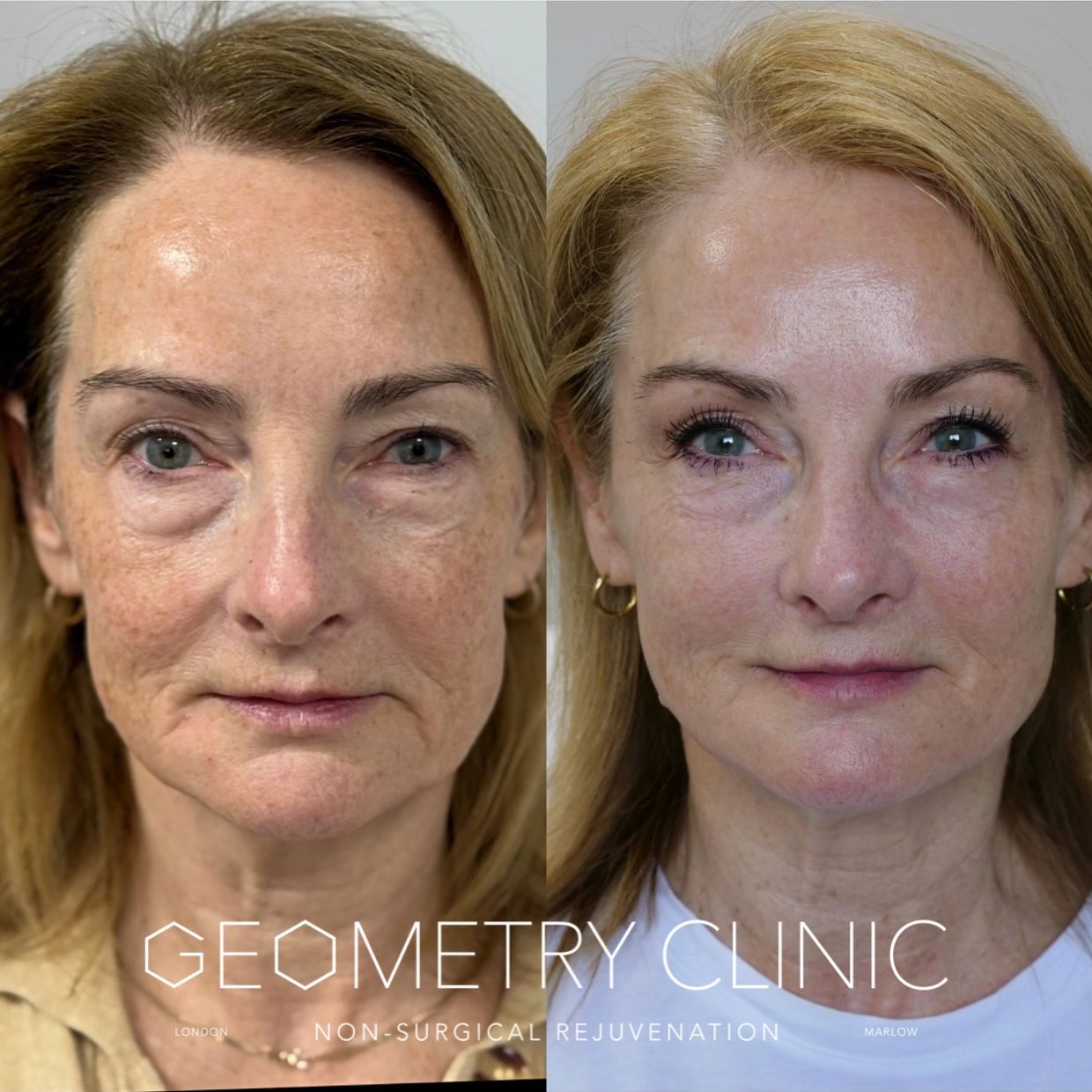 65 year old woman
1 year difference
3 sessions of BBL HEROic last year
1 session of Radiesse 3 mon