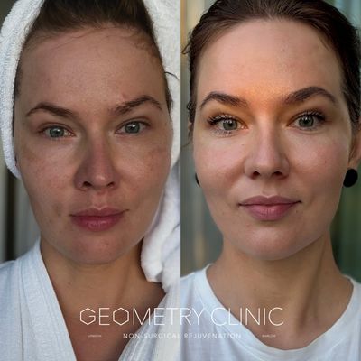 Result after 1 session of BBL MOXI
Clearer even radiant healthy skin