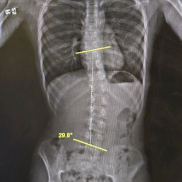 X-ray showing spinal curvature with angles marked.