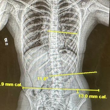 X-ray showing a curved spine with measurements.