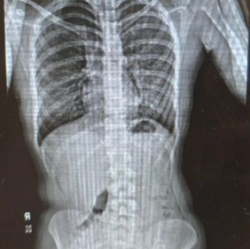 X-ray of a human torso and spine.