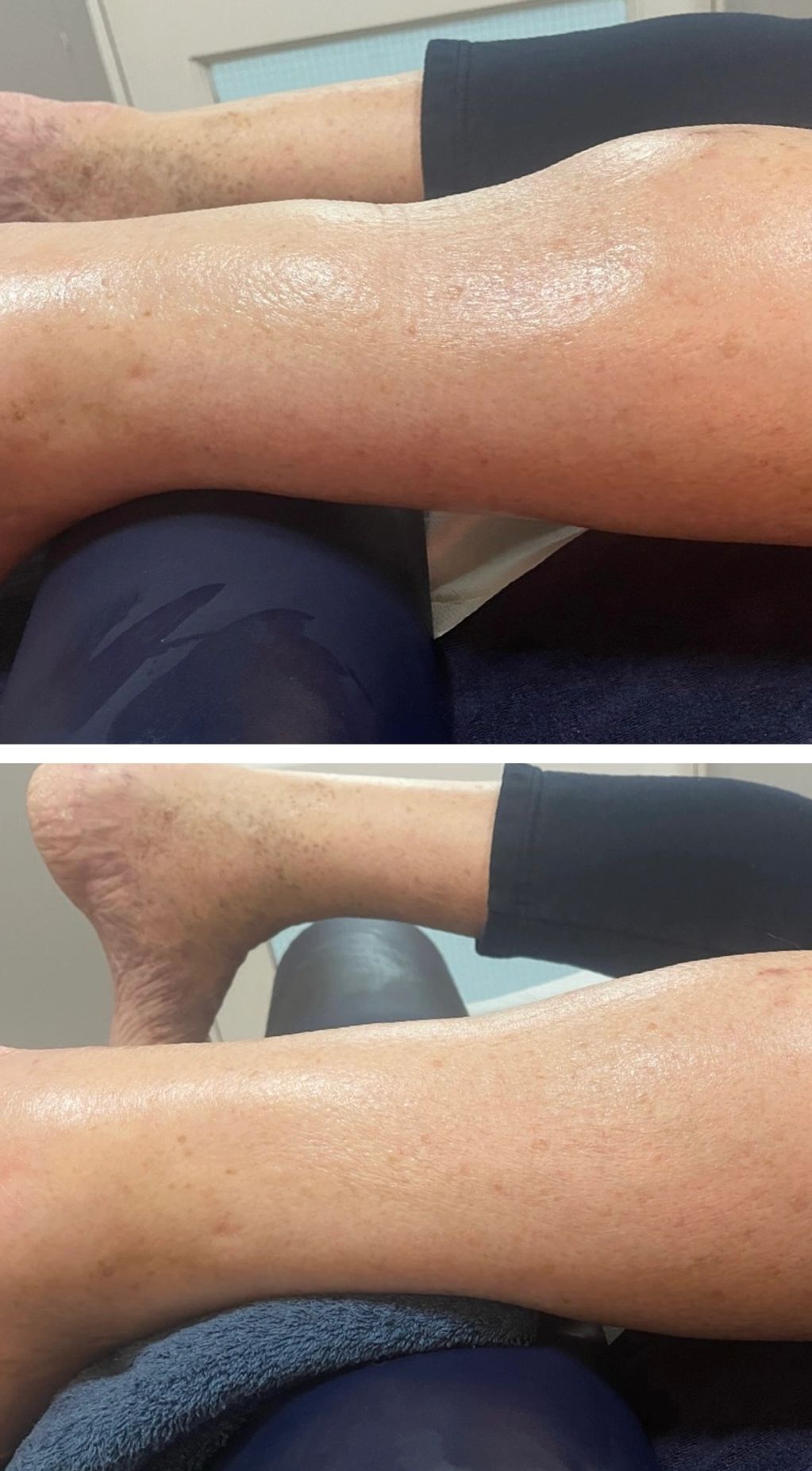 Before and after treatment following ankle surgery.