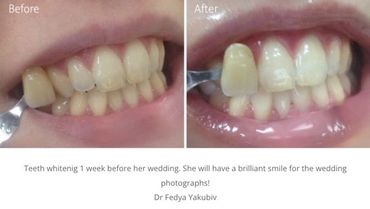 Teeth whitening