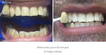 Teeth whitening