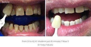 Teeth whitening