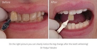 Teeth whitening
