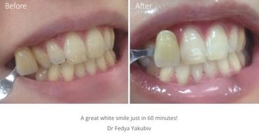 Teeth whitening