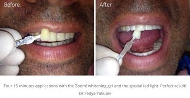 Teeth whitening
