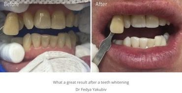 Teeth whitening