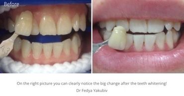 Teeth whitening