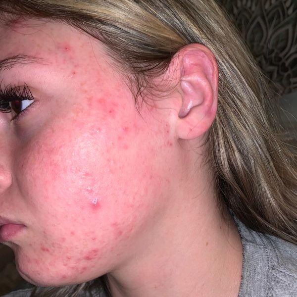 Close-up of a young woman's face with acne and redness on her cheek.