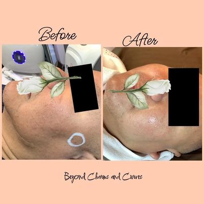 Before-and-after facial skin treatment showing improved complexion and smoothness.