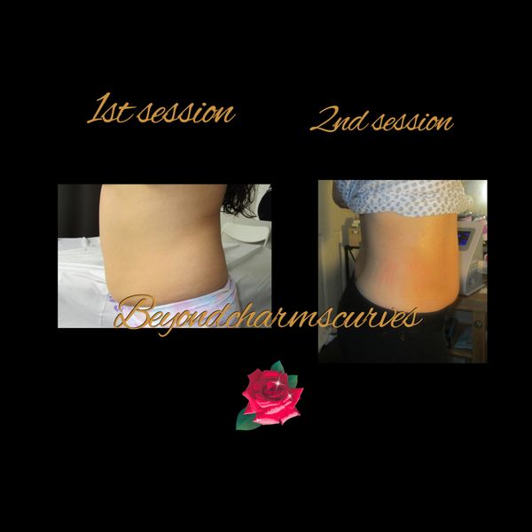 She was very happy for obtaining the "11" lines in her abdomen after 2 sessions!