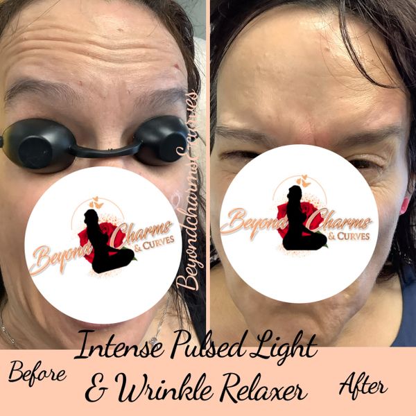 IPL result and Botox injection