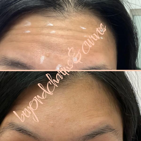 Before and after photo after Botox injection