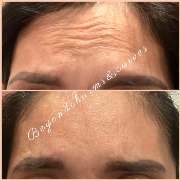 Botox treatment result