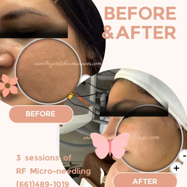 RF micro needling before and after photos