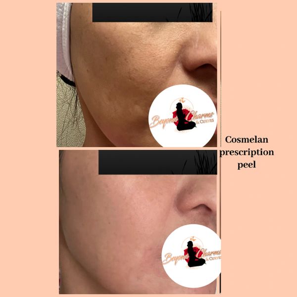 Cosmelan MD before and after for Melasma and dark spots