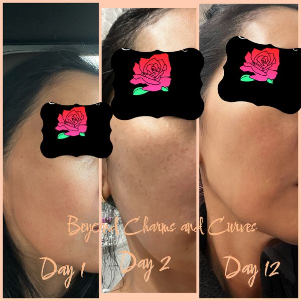 IPL result before and after photos