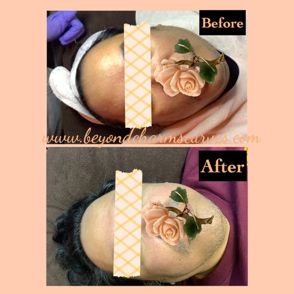 Microneedling before and after photos