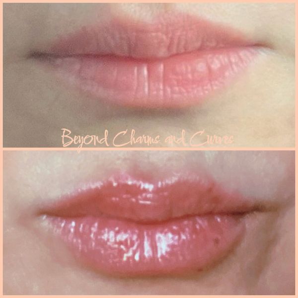 Lip filler injection before and after using Juvederm