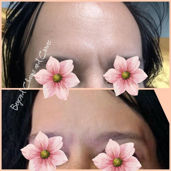 Before and after photo of Botox treatment to forehead