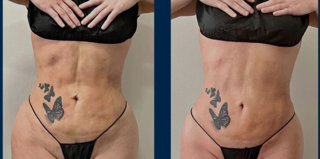 Post-Op Care Cambridge | Thanyia Aesthetics