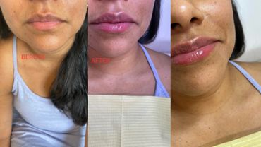Before and After pictures of a Lip Filler performed by Martha Lewis-Sandari, PA.