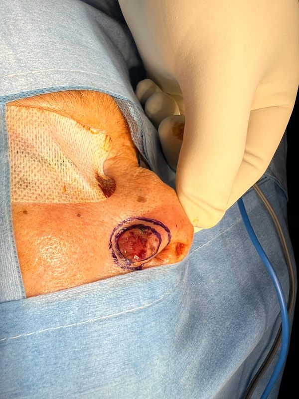 BCC over ala of nose
surgery for skin cancer over face
