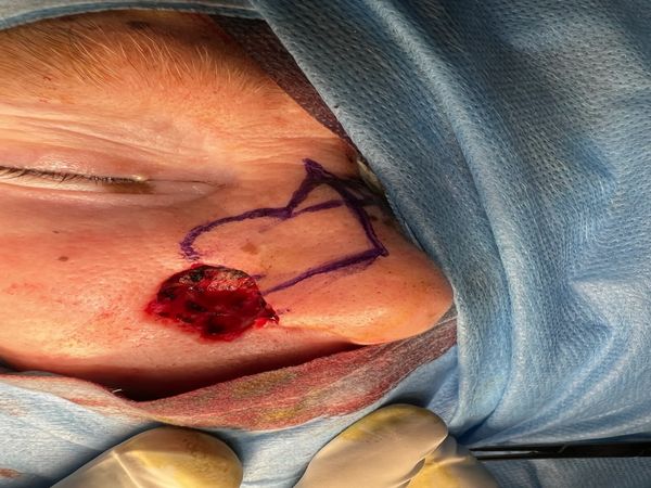 skin cancer over face surgery