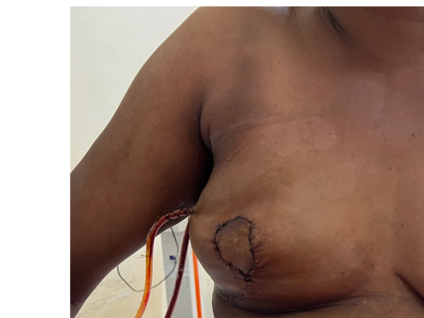 breast reconstruction for breast cancer