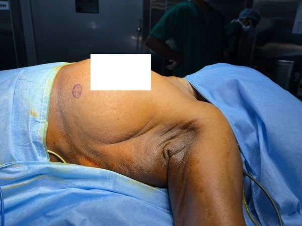 Racquet mammoplasty - breast reconstruction
breast reconstruction after cancer surgery