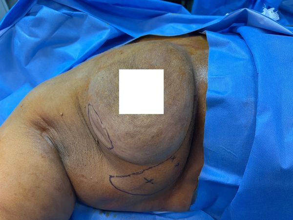 Breast reconstruction with LICAP flap