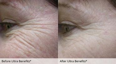 ultra benefits Sarasota natural skin care island cosmeceuticals acupuncture facial rejuvenation