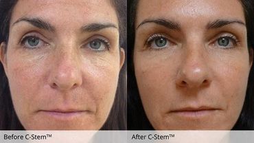 C-Stem Sarasota natural skin care island cosmeceuticals acupuncture facelift facial rejuvenation