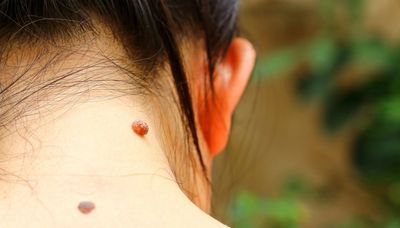 The greatest benefit of mole removal is that it can potentially save your life.