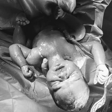 Delayed Cord Clamping.