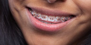Bouche avec dents appareillés. Traitements orthodontiques.