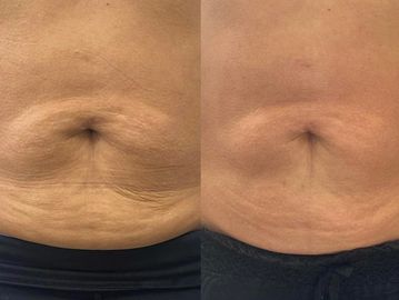 Before and after pictures of men's belly after meso therapy
