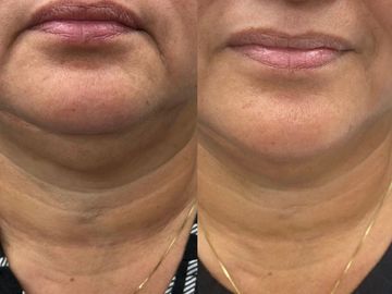 Before and after pictures of woman double chin fat 