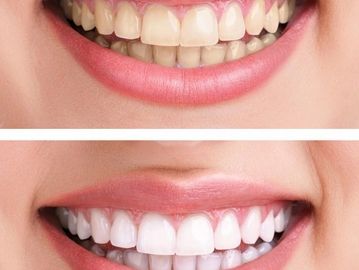 Before and after pictures of white teething treatment