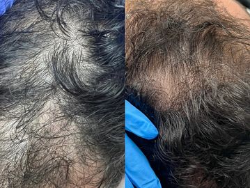 Before and After pictures of meso hair treatment