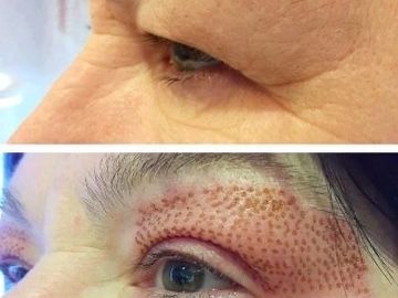 Before and after images of fibroblast treatment